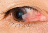 (Foto fuente Shepard Eye Center)
