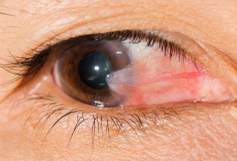 Pterigión o carnosidad en los ojos: ¿qué es y qué lo causa?