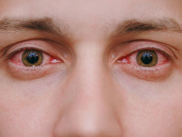 Secreción ocular: síntomas de esta afección que puede ser de preocupación