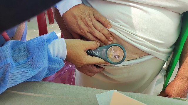 Chimbote: 72 casos de cáncer de piel fueron detectados durante el 2022