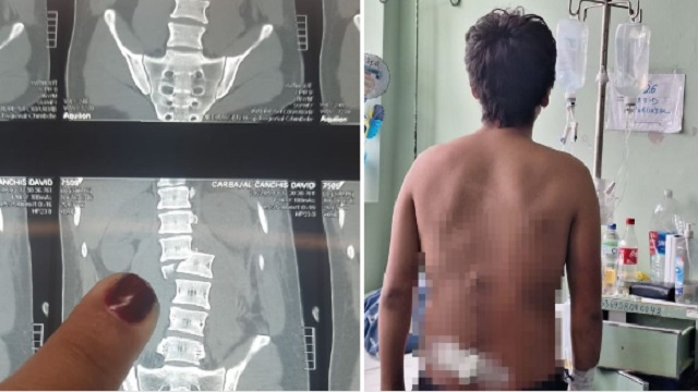 Hospital Regional: menor vuelve a caminar tras riesgosa cirugía en la columna vertebral