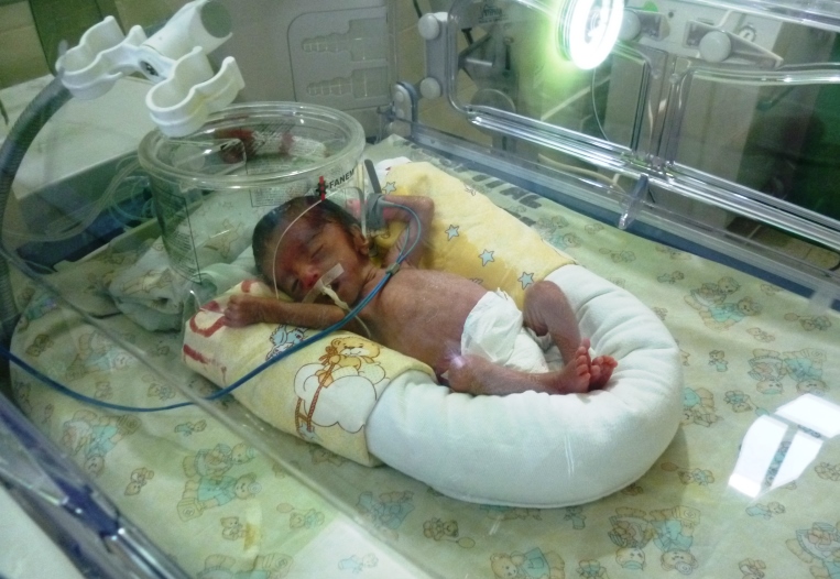 Oftalmólogos de “La Caleta” salvan de ceguera a bebé prematuro
