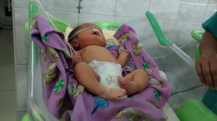 Chimbote: En hospital La Caleta nace bebe con dos narices y necesita ayuda 