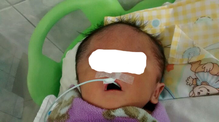 Chimbote: Esperan transferencia de bebe que nació con dos narices 
