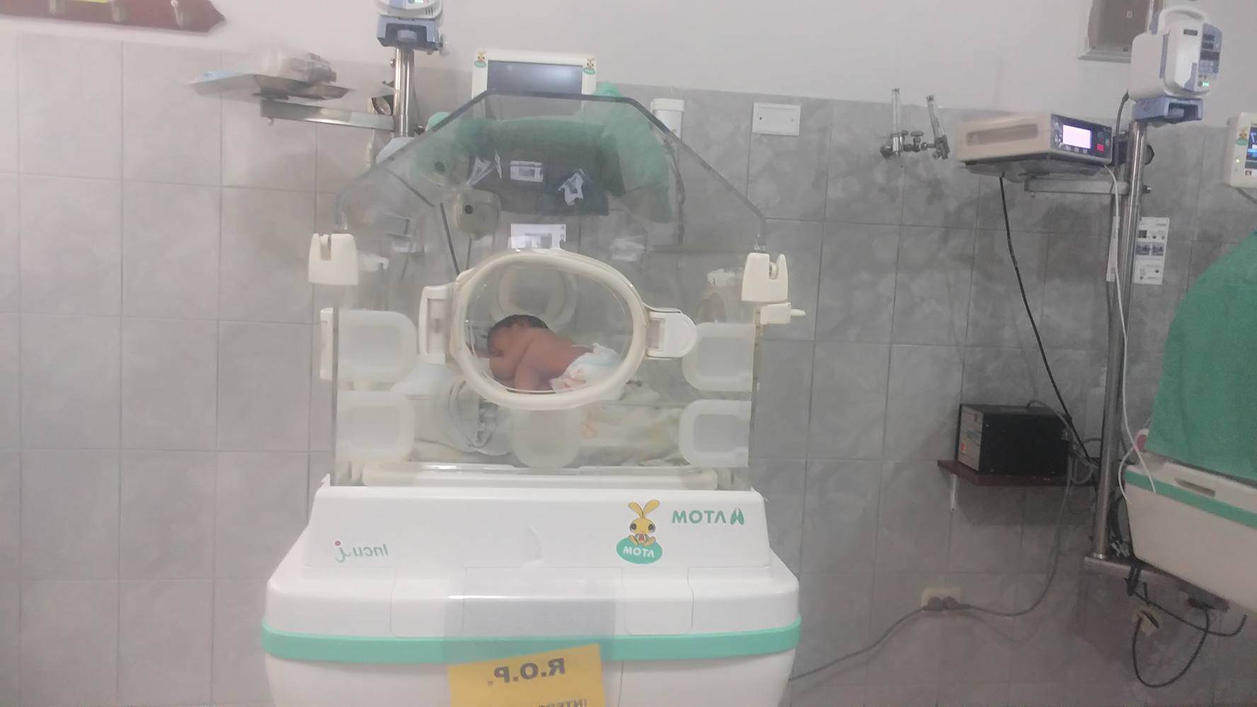 Chimbote: en “La Caleta” nace niña con medula espinal expuesta