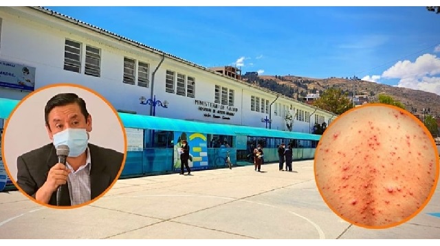 Confirman primer caso de viruela del mono en Huaraz, se trata de un varón de 30 años