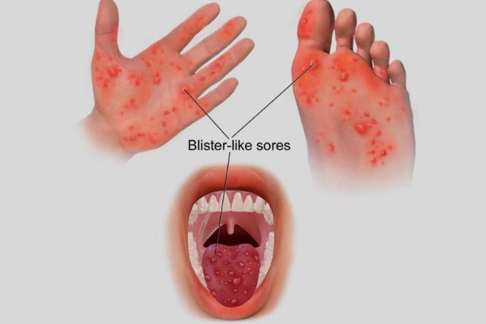 Son 125 casos de niños con la enfermedad de manos, pies y boca en la región Áncash