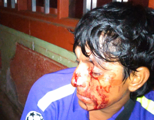 Denuncian por lesiones graves y desfiguración de rostro a efectivo policial de Chimbote