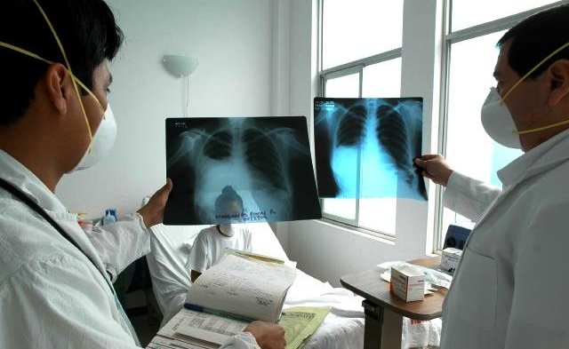 Chimbote registra más del 50% de casos de TBC en  Ancash