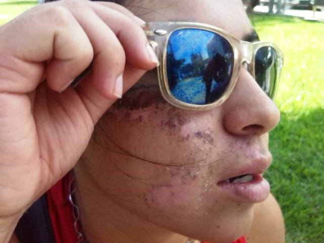 Joven denunció que su expareja la arrastró por la calle y le desfiguró el rostro en Chimbote