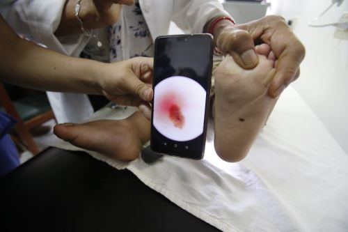 Le informamos cómo reconocer un lunar cancerígeno