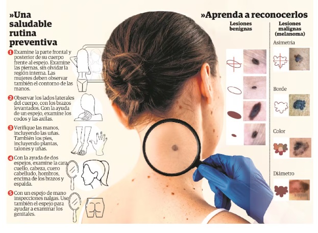 Debemos estar alerta ante lunares que aparecen de manera repentina en nuestro cuerpo