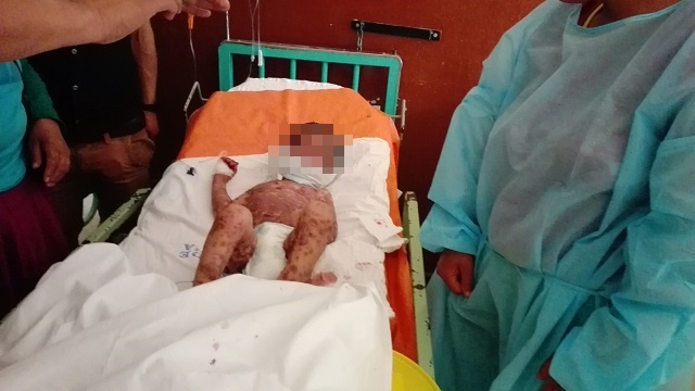 Niño de Huaraz muere con varicela y otro menor de Chimbote será evacuado al Hospital del Niño