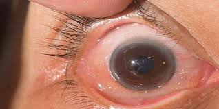 “La catarata”, es la primera causa de ceguera en el Perú y un problema de salud pública