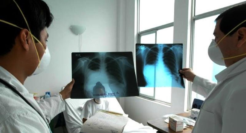 Este año se reportaron 104 nuevos casos de TBC en la costa de Ancash