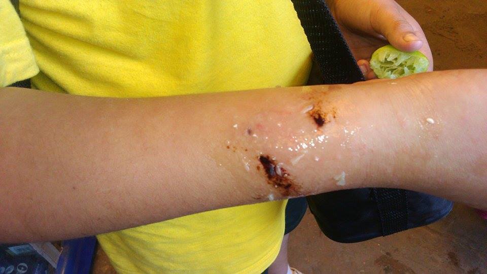 Chimbote: menor fue atacado por un perro cuando salía de su colegio