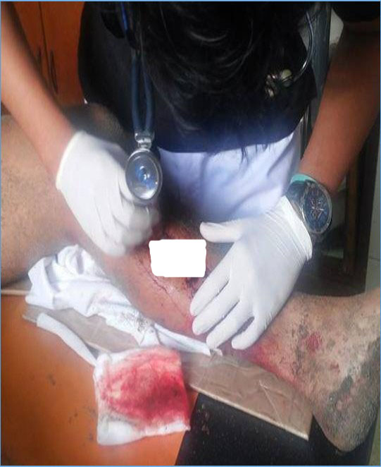 Chimbote: Pescador sufre profundo corte en la pierna izquierda