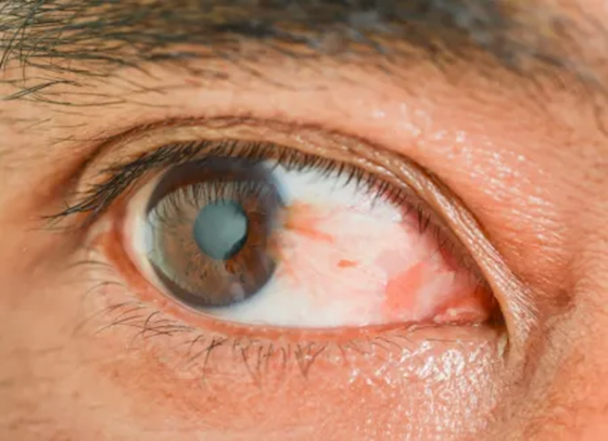 Pterigión: qué es, sus causas, síntomas tratamiento