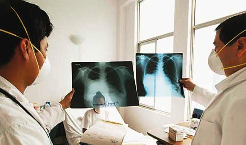 Más de 4,000 casos nuevos de TBC atiende Essalud al año