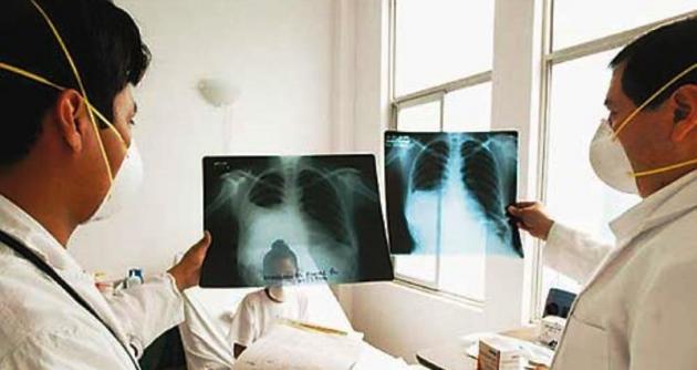 Perú: casos de pacientes con tuberculosis disminuyeron en el 2013