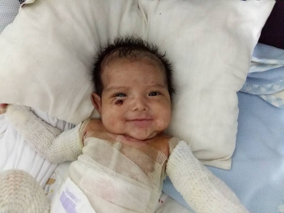 Chimbote: Este lunes inician campaña a favor de Samuelito, bebe piel de mariposa 