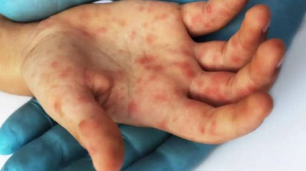 Perú el segundo país de América con más casos de viruela del mono, asevera decano del Colegio Médico   